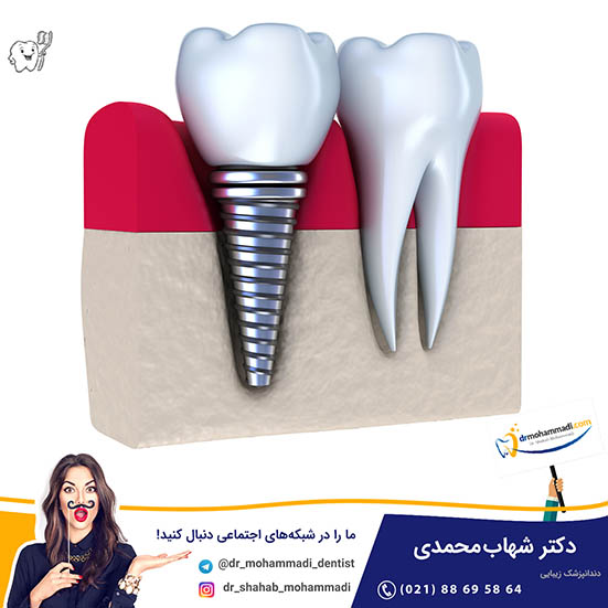 سوالی که ممکن است شنیده باشید: عوارض ایمپلنت فوری - کلینیک دندانپزشکی دکتر شهاب محمدی